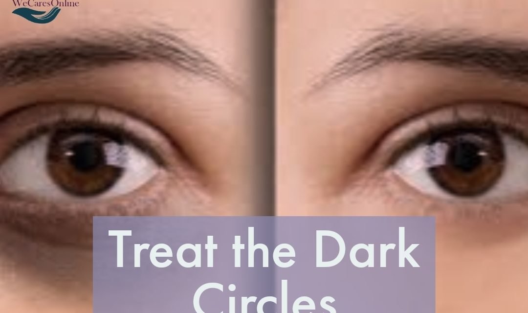 How to cure DARK CIRCLES/ Black circle